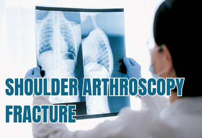 Shoulder Arthroscopy Fracture by Dr Karthik Gudaru